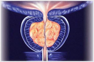 illustration of gland ablation