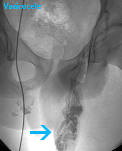 x ray image of left-side varicocele
